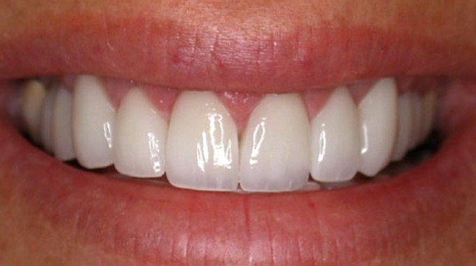 white teeth 2000
