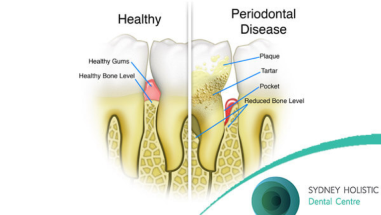 Natural Remedies For Periodontal Disease