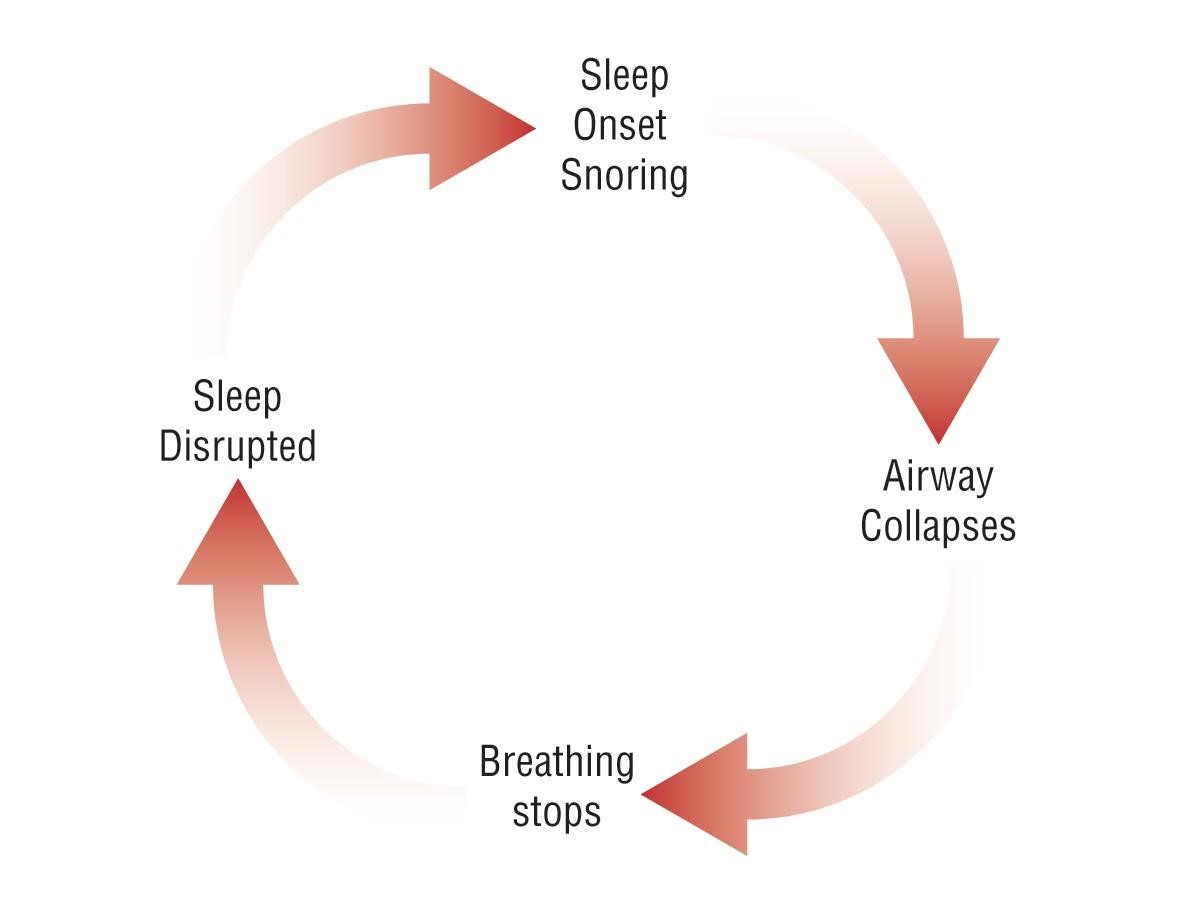 Snoring And Obstructive Sleep Apnea - Sydney Holistic Dental Centre