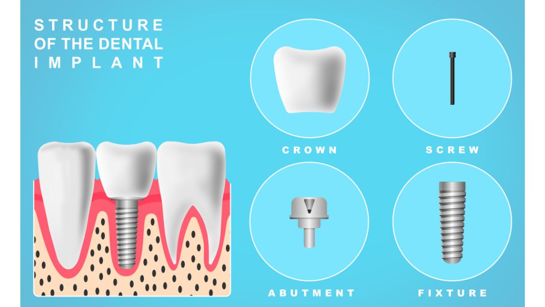 Dental Implant Anatomy