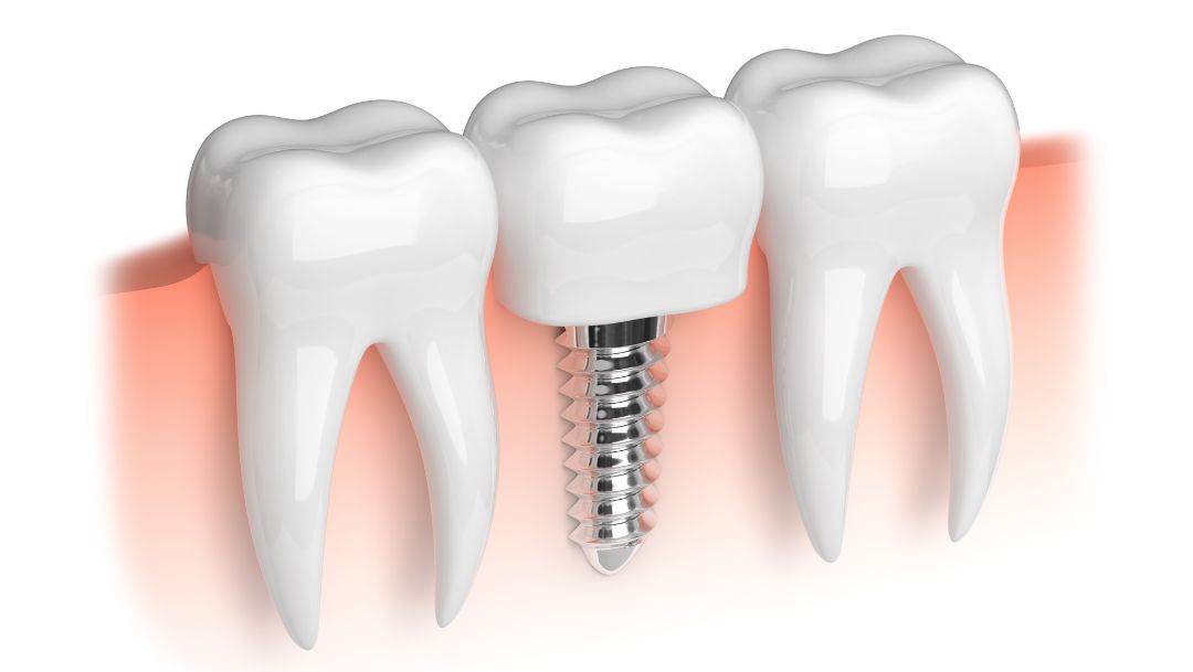 Dental Implant replacement